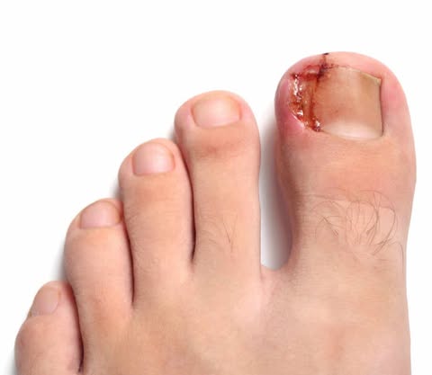 Tratamiento de Uñas Encarnadas